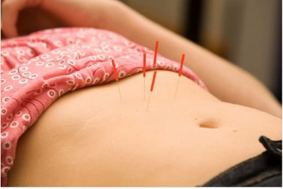 Acupuncture