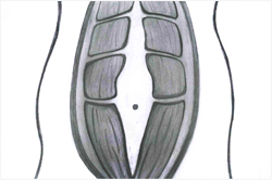 Seperation of Rectus Abdominis